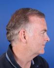 After Hair Transplant&nbsp;2 Sessions (Areas)